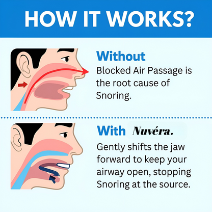 Nuvéra® Anti Snoring Mouthpiece